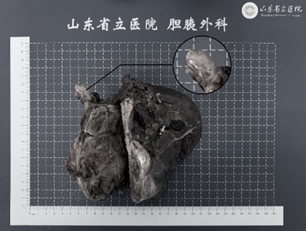 山東第一醫(yī)科大學(xué)附屬省立醫(yī)院多學(xué)科協(xié)作成功實(shí)施巨大肝癌伴高危癌栓轉(zhuǎn)化治療